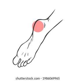 Leg with heel pain. Orthopedic disease plantar fasciitis. Vector isolated outline illustration