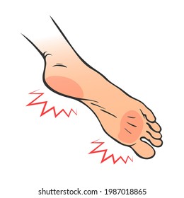 Leg with heel pain. Orthopedic disease plantar fasciitis. Vector isolated outline illustration