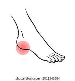 Pierna con dolor de tacón. Enfermedad ortopédica fascitis plantar. Belleza y salud de los pies. Ilustración de contorno aislado del vector