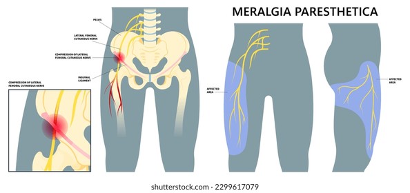 Concepto médico para la causa del dolor muscular y muscular que se relaciona con trastornos nerviosos