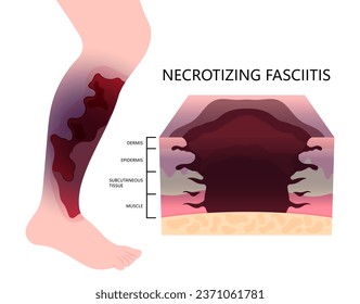 Leg injury with skin infection of Necrotizing fasciitis cause limb pain and scab fat cancer health care