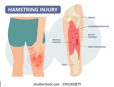 leg knee biceps hip pulled tear injury grade pain running thigh examine cramp soccer football lacrosse pull sport athlete RICE torn skater player treat IT band first aid stretching back pelvis