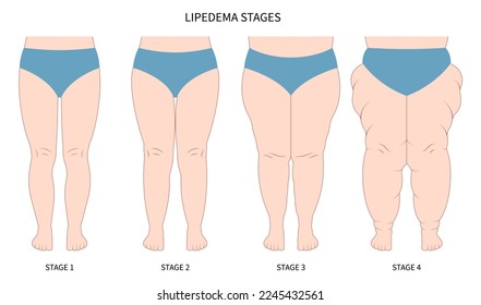 leg lipedema weight loss for Oedema and lipoedema cellulitis