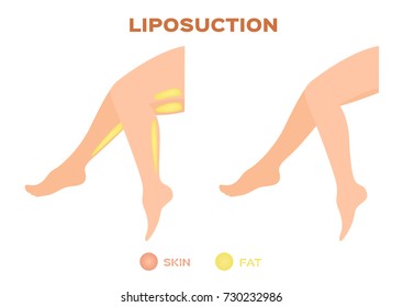 Leg liposuction before and after , fat , diet , surgery