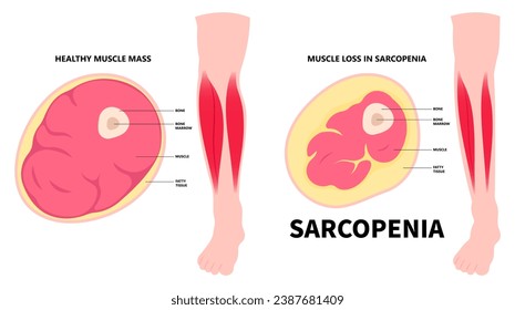 Debilidad muscular de la pierna y de la pantorrilla que se muestra frente a la vista con anatomía de sección transversal