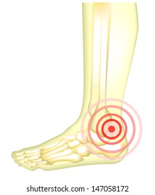 Leg pain