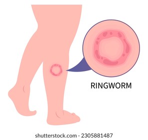 Leg skin psoriasis ringworm eczema or Jock itch fungal rash body fungus tinea cruris dermatophytosis Itchiness Scaly athlete's circular excessive infection