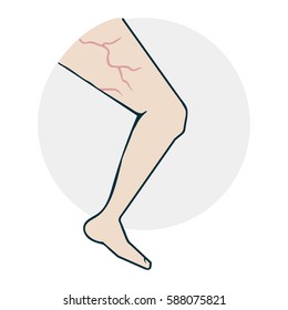 Leg with varicose veins. Drugs Icon on medical subjects. Illustration of a funny cartoon style