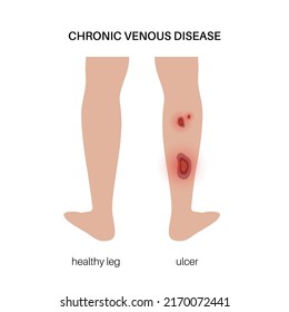 Leg wound concept. Trophic ulcer, blisters or sores on the human body. Stage of varicose disease on female foot. Dermatology medical poster flat vector isolated illustration on white background.