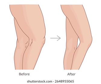 Pernas antes e depois da perda de peso. Emagrecimento da ilustração do vetor de pernas.