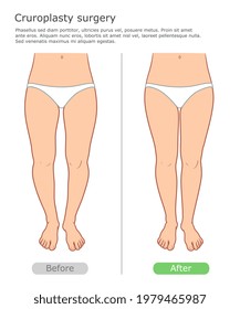 Legs cruroplasty before and after surgery. Correction of shape and size of the lower leg  with implantation.