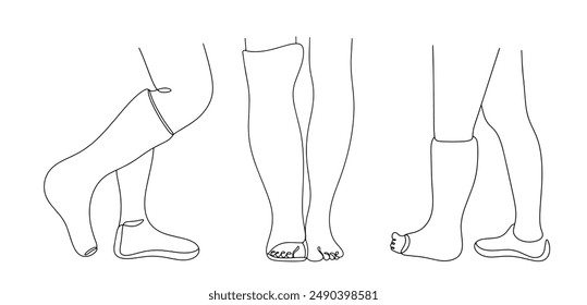 Legs of people with fractures in the ankle area. Plaster on the leg for proper treatment of the fracture. Fixed fixation of leg bones. Vector.