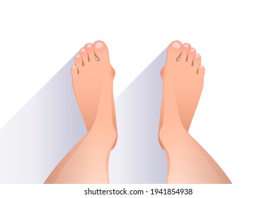 Legs of woman with deformities of joints connecting the big toe to the foot, redness on deformed joints, top view of bare feet over white background. Hallux valgus concept