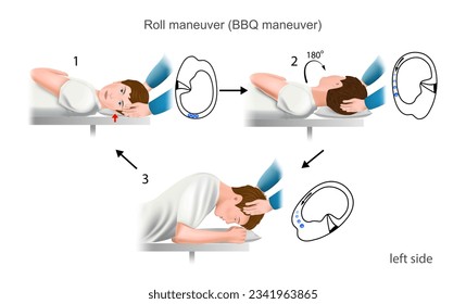 Lempert roll maneuver BBQ a practical guide to the treatment of benign positional paroxysmal vertigo (bppv). With damage to the left ear. Training manual, education. Vector. 