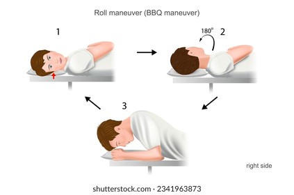 Lempert roll maneuver BBQ a practical guide to the treatment of benign positional paroxysmal vertigo (bppv). With damage to the right ear. Training manual, education. Vector. 