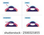 Lens implantation poster. Nearsightedness and astigmatism treatment, healthy eye with minimally invasive procedure EVO ICL. Human visual system anatomy. Cataract surgery flat vector flat illustration