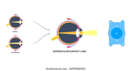 Lens implantation poster. Nearsightedness and astigmatism treatment, healthy eye with minimally invasive procedure EVO ICL. Human visual system anatomy. Cataract surgery flat vector flat illustration