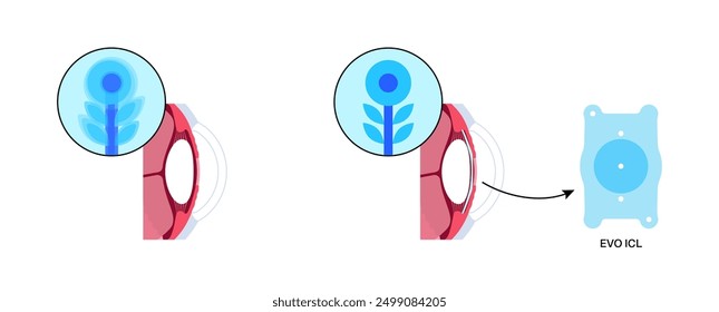 Lens implantation poster. Nearsightedness and astigmatism treatment, healthy eye with minimally invasive procedure EVO ICL. Human visual system anatomy. Cataract surgery flat vector flat illustration