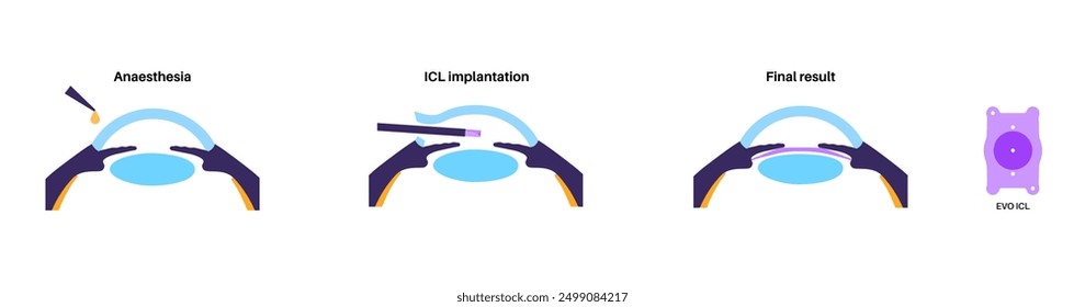 Lens implantation poster. Nearsightedness and astigmatism treatment, healthy eye with minimally invasive procedure EVO ICL. Human visual system anatomy. Cataract surgery flat vector flat illustration