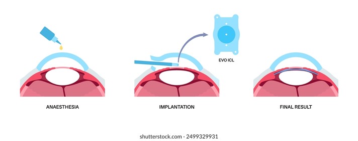 Lens implantation poster. Nearsightedness and astigmatism treatment, healthy eye with minimally invasive procedure EVO ICL. Human visual system anatomy. Cataract surgery flat vector flat illustration