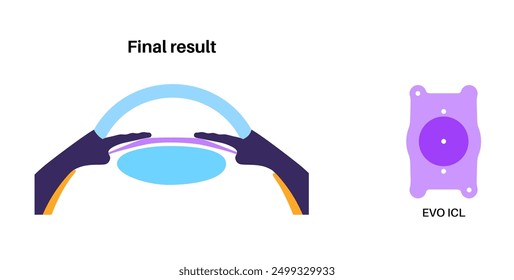 Lens implantation poster. Nearsightedness and astigmatism treatment, healthy eye with minimally invasive procedure EVO ICL. Human visual system anatomy. Cataract surgery flat vector flat illustration