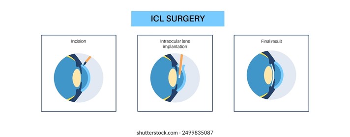 Cartel de implantación de lentes. Tratamiento de la miopía y el astigmatismo, ojo sano con procedimiento mínimamente invasivo EVO ICL. Anatomía del sistema visual humano. Ilustración plana de Vector plano de cirugía de cataratas