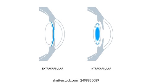 Lens implantation poster. Nearsightedness and astigmatism treatment, healthy eye with minimally invasive procedure EVO ICL. Human visual system anatomy. Cataract surgery flat vector flat illustration