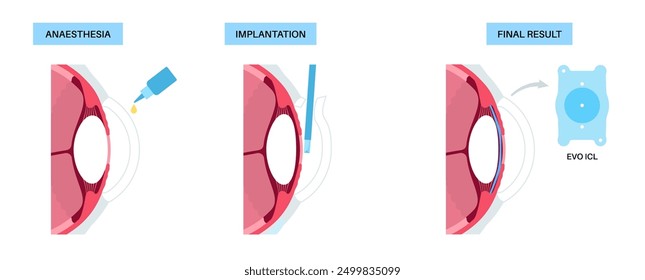 Lens implantation poster. Nearsightedness and astigmatism treatment, healthy eye with minimally invasive procedure EVO ICL. Human visual system anatomy. Cataract surgery flat vector flat illustration