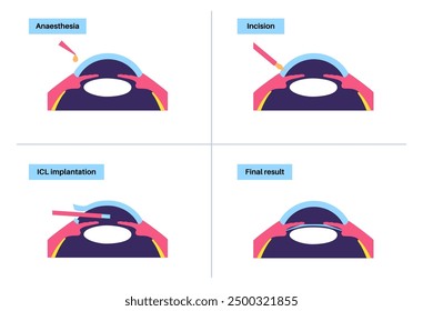 Lens implantation poster. Nearsightedness and astigmatism treatment, healthy eye with minimally invasive procedure EVO ICL. Human visual system anatomy. Cataract surgery flat vector flat illustration