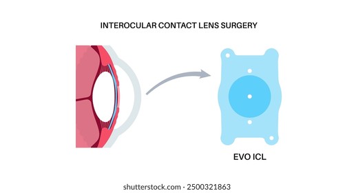 Lens implantation poster. Nearsightedness and astigmatism treatment, healthy eye with minimally invasive procedure EVO ICL. Human visual system anatomy. Cataract surgery flat vector flat illustration