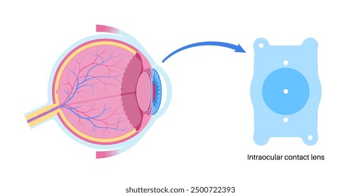 Lens implantation poster. Nearsightedness and astigmatism treatment, healthy eye with minimally invasive procedure EVO ICL. Human visual system anatomy. Cataract surgery flat vector flat illustration