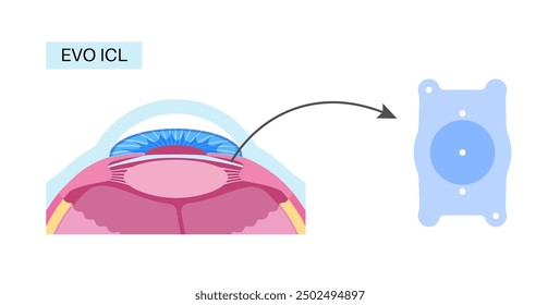 Lens implantation poster. Nearsightedness and astigmatism treatment, healthy eye with minimally invasive procedure EVO ICL. Human visual system anatomy. Cataract surgery flat vector flat illustration