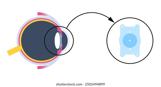 Cartel de implantación de lentes. Tratamiento de la miopía y el astigmatismo, ojo sano con procedimiento mínimamente invasivo EVO ICL. Anatomía del sistema visual humano. Ilustración plana de Vector plano de cirugía de cataratas