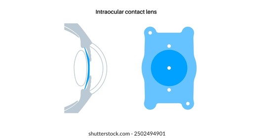 Lens implantation poster. Nearsightedness and astigmatism treatment, healthy eye with minimally invasive procedure EVO ICL. Human visual system anatomy. Cataract surgery flat vector flat illustration