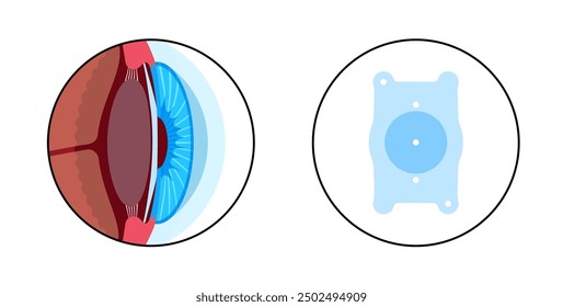 Lens implantation poster. Nearsightedness and astigmatism treatment, healthy eye with minimally invasive procedure EVO ICL. Human visual system anatomy. Cataract surgery flat vector flat illustration