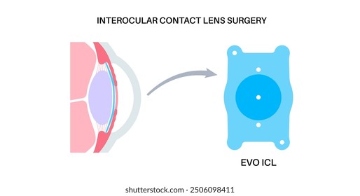 Lens implantation poster. Nearsightedness and astigmatism treatment, healthy eye with minimally invasive procedure EVO ICL. Human visual system anatomy. Cataract surgery flat vector flat illustration