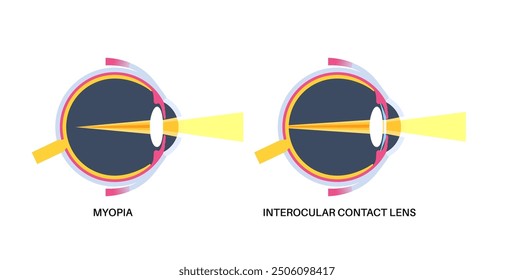 Lens implantation poster. Nearsightedness and astigmatism treatment, healthy eye with minimally invasive procedure EVO ICL. Human visual system anatomy. Cataract surgery flat vector flat illustration