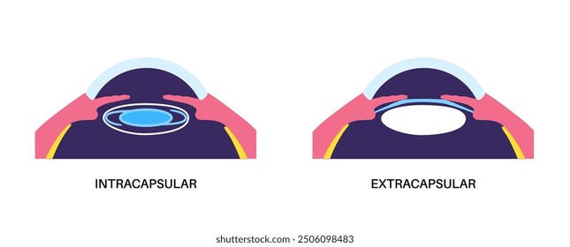 Lens implantation poster. Nearsightedness and astigmatism treatment, healthy eye with minimally invasive procedure EVO ICL. Human visual system anatomy. Cataract surgery flat vector flat illustration