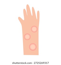 Concepto de enfermedad de la lepra. Ilustración vectorial