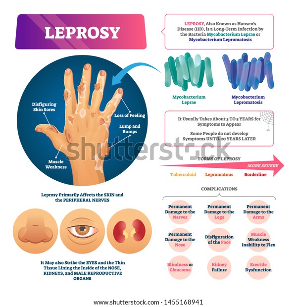 Leprosy vector illustration. Labeled medical\
bacterial infection disease scheme. Educational list with\
complications and affected organs. Loss of feeling, lump and bumps\
and disfiguring skin\
symptoms.