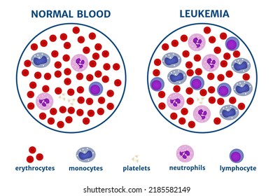 Leukemia Blood Cancer Bodies Under Microscope Stock Vector (Royalty ...