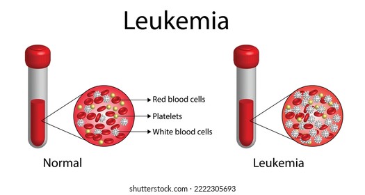 Leucemia, cáncer de sangre. Diferencia entre sangre normal saludable y cáncer de sangre. Tubo de ensayo con eritrocitos, plaquetas y linfocitos. Ilustración vectorial.