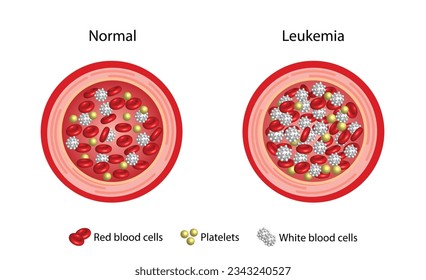 Leukemia, blood cancer. Difference between healthy normal blood and blood cancer. Test tube with erythrocytes, platelets and lymphocytes. Vector illustration.