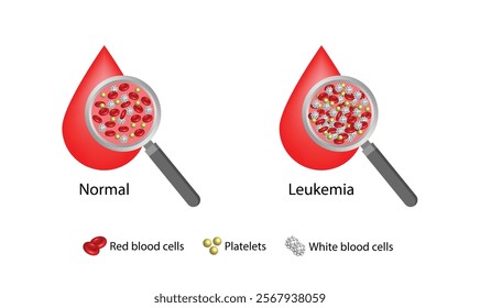 Leukemia, blood cancer. Difference between healthy normal blood and blood cancer. Blood droplet, erythrocytes, platelets and lymphocytes. Vector illustration.