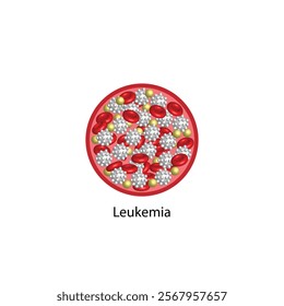 Leukemia, blood cancer. Difference between healthy normal blood and blood cancer. Blood droplet, erythrocytes, platelets and lymphocytes. Vector illustration.