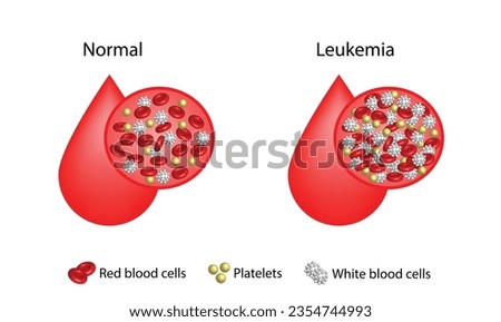 Leukemia, blood cancer. Difference between healthy normal blood and blood cancer. Test tube with erythrocytes, platelets and lymphocytes. Vector illustration.