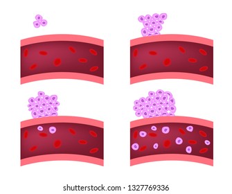 Leukemia And Blood Cancer Stages Vector / Tumor