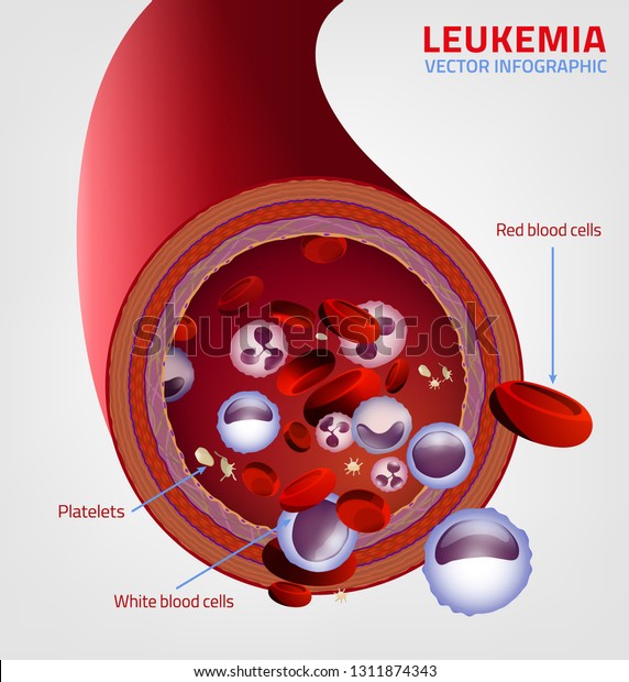 Leukemia Blood Vessel Cut Under Microscope Stock Vector (Royalty Free ...