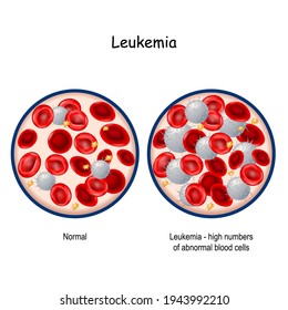 Leukemia. Comparison And Difference Between Blood Of Healthy Person And  Blood Cancer. Close-up Of Blood Vessel With Erythrocyte, Platelets And Lymphocytes