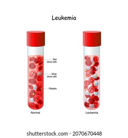 Leukemia. Comparison And Difference Test Tube With Normal Blood And Blood Cancer. Close-up Of Red Blood Cells And Lymphocytes. Vector Illustration